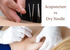 Acupuncture vs Dry Needle