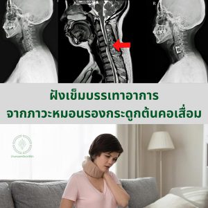 กระดูกต้นคอเสื่อม