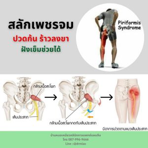 ปวดสะโพก ปวดชาร้าวลงขา สลักเพชรจม￼
