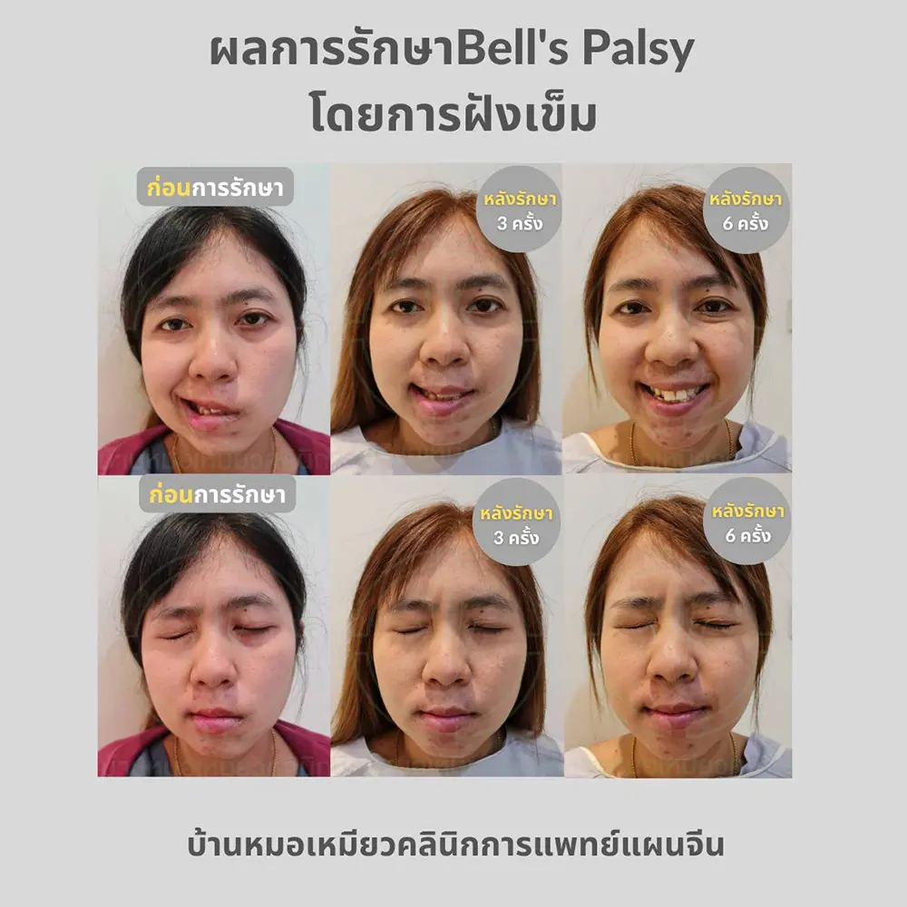 ผลการรักษา Bell's Palsy โดยการฝังเข็ม